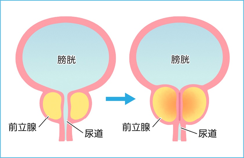 前立腺肥大症とは