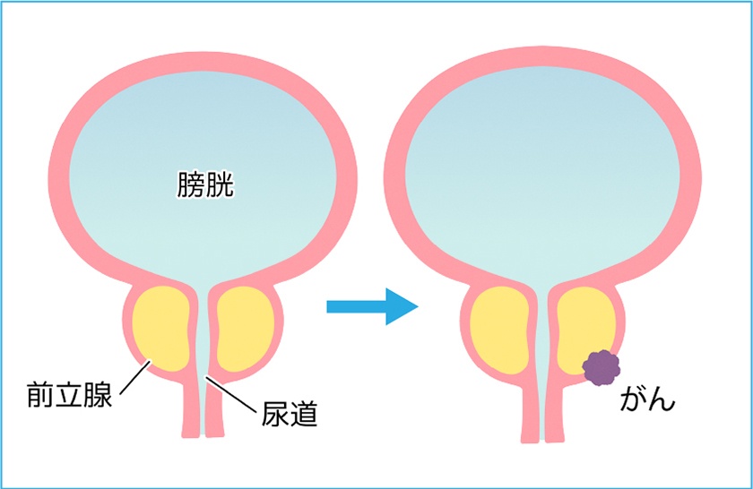 前立腺がんとは